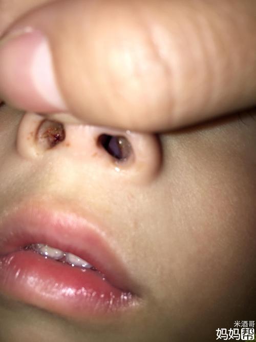 宝宝鼻子长东西了【吓】