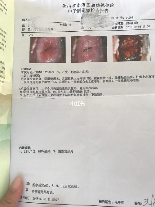 宫颈上皮内瘤变iii级,hpv16阳性治愈(接上一篇) 第二天9点_妇科_hpv