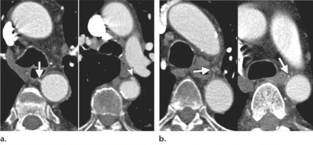 支气管动脉的解剖和变异——医学影像人课件解读