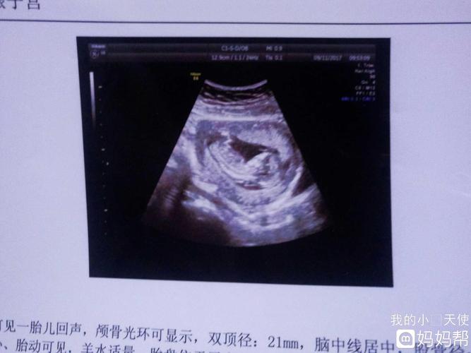 三个月做的彩超,谁能看出来是男