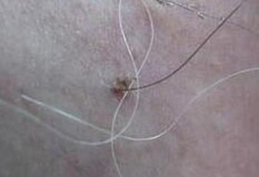 无踪人被阴虱感染后,皮肤常有莫名的瘙痒,皮肤表面有红点或青灰色小点