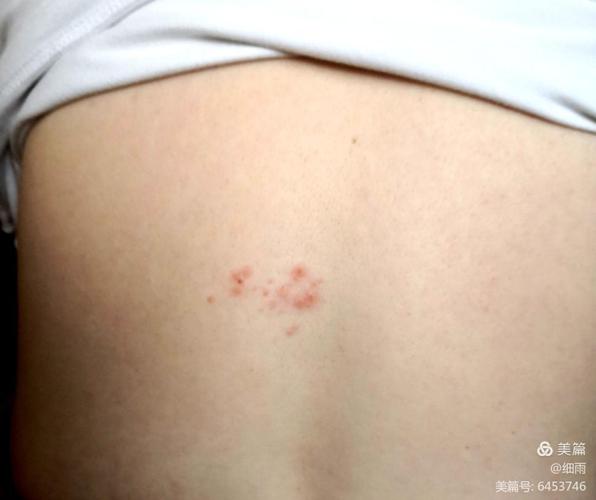 12.27 疱疹位于脊柱左侧,腰部上方