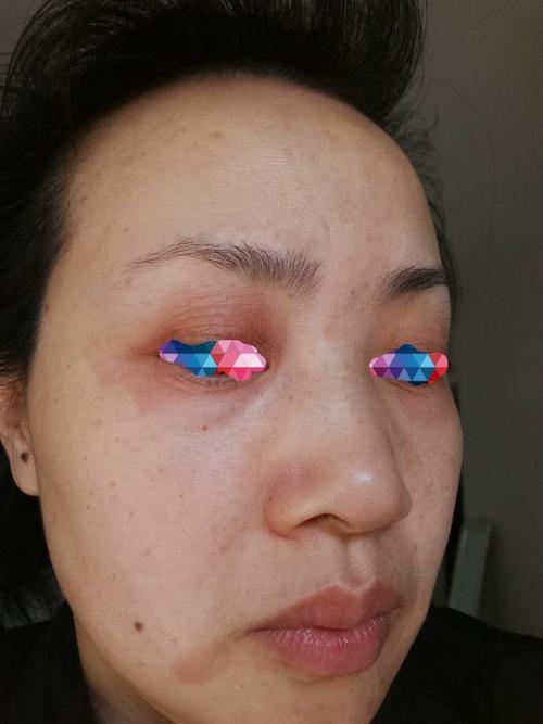 眼睑和皮肤反复痒,红,起皮,是过敏吗?还是脂溢性皮炎?