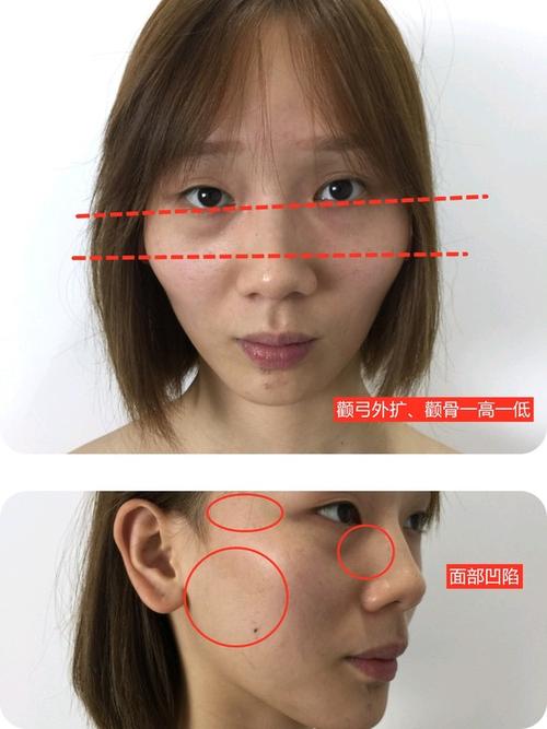 颧骨案例解析#做完颧骨磨骨太太太后悔了!
