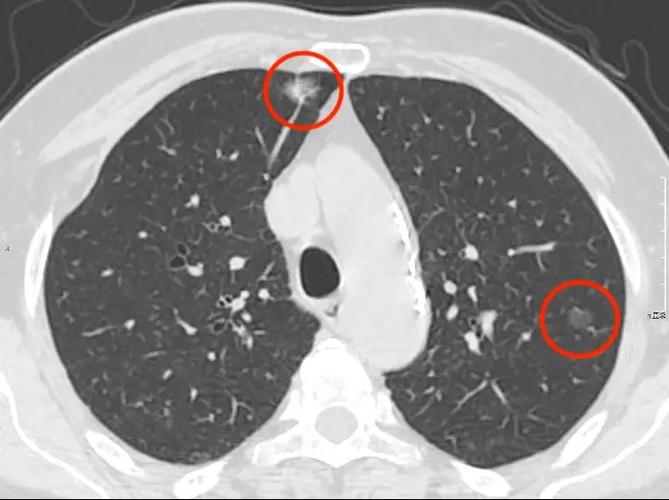 最终行手术切除,病理结果为右肺上叶微浸润性腺癌及原位癌.