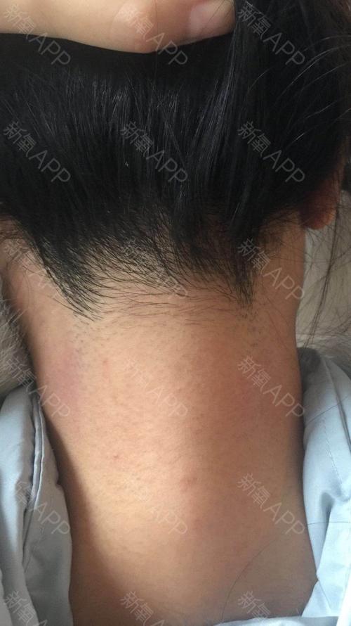 脱发际线怎么样_氧气_1uje1b120的美丽日记_新氧整形