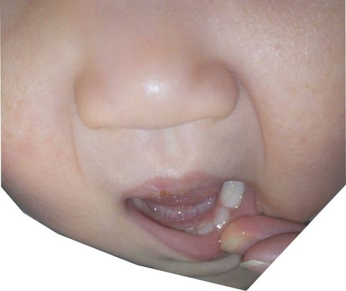 牙齿里面这白色的是什么,需要看医生吗?宝宝两岁了.