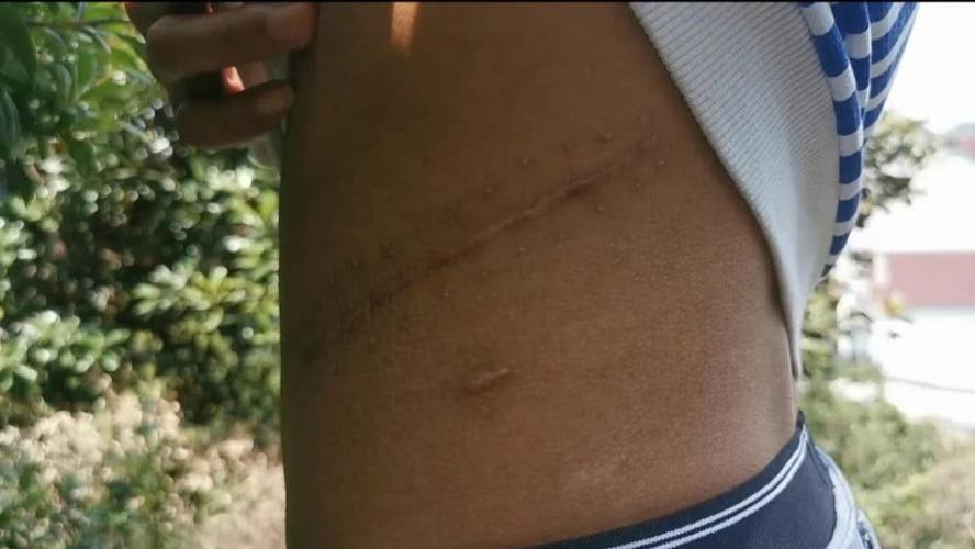 4月15日,李瑞卖肾后留下的手术刀口疤痕.新京报记者 李英强 摄