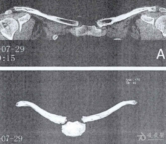 临床随笔(一):胸锁关节半脱位!