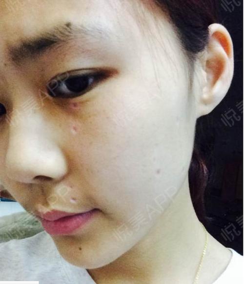 激光点痣_去痣_皮肤美容_爱情里的嘲笑声分享图片1