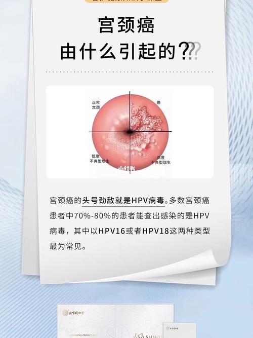 宫颈癌预防_宫颈癌_hpv_医疗健康_医疗健康其他