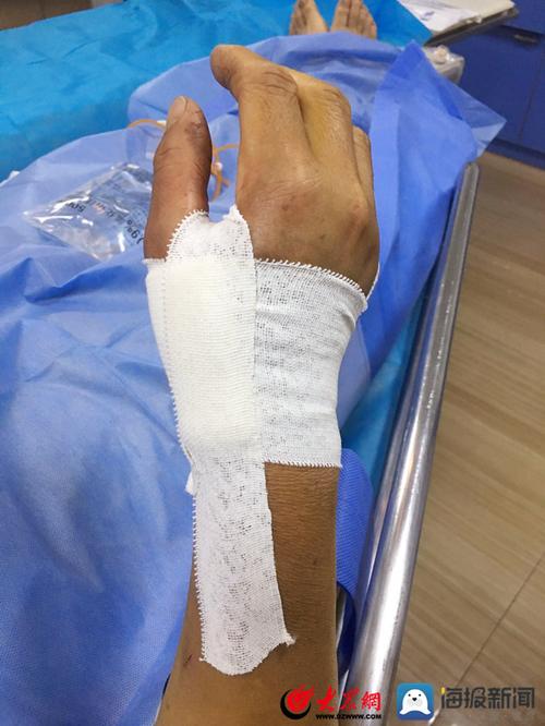 术后加压包扎减少疼痛什么是远端桡动脉穿刺技术?