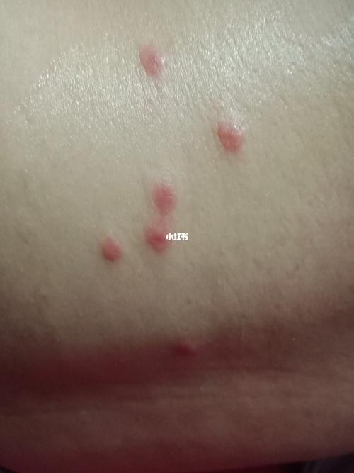 请问集美们有知道图二的红疙瘩是什么吗?_皮肤病_医疗