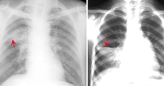 大叶性肺炎症状体征