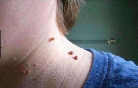 避免感染hpv要学会拒绝这4类男人易携带hpv