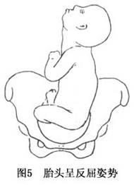 分为骶左前,骶左横,骶左后,骶右前,骶右横,骶右后6种胎方位