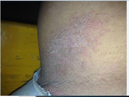 以前长过,医生说是玫瑰糠疹,后来好了,不知道怎么回事今年又长了,就在