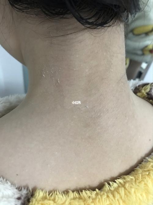脖子发黑黑棘皮色素沉着去黑卤米松乳膏