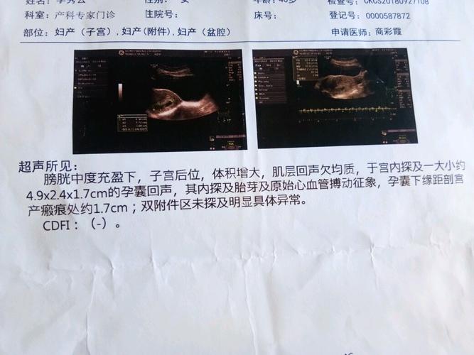 这次是意外怀孕,已经有一对双胞胎姐妹了!