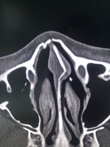 其它 鼻骨解剖及ct诊断 写美篇鼻骨(nasal bone) 下图:鼻额缝(蓝箭)
