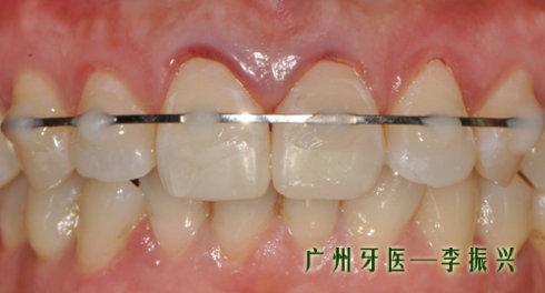 因为牙齿有松动,要进行松牙固定,等牙齿长稳就行了