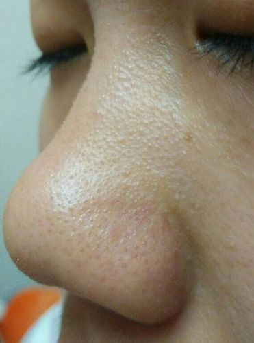 鼻梁长了一个大痘痘,不痛不痒很硬,突出,半个多月了,怎么办!