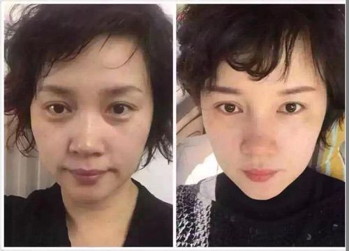 980元/次水光针 胜过四季狂补水