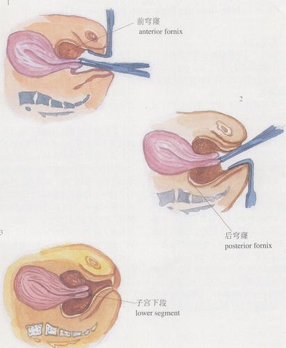 (图) 穹窿纱布块填塞术