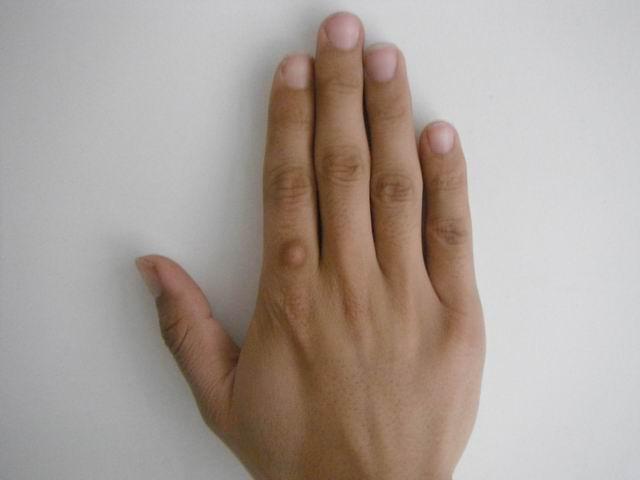 浅谈纤维瘤的知识