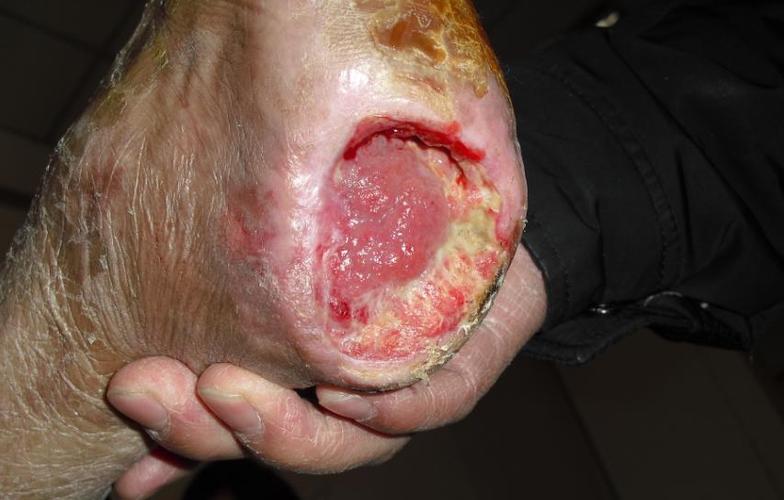 蛆医生---糖尿病足的克星