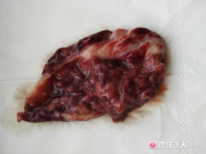 试管婴儿生化掉出囊状物有类似的姐们看看这是什么附图