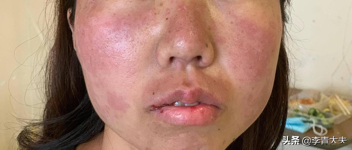 这不是皮肤过敏而是红斑狼疮