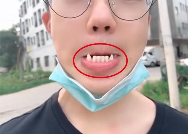 17岁男孩长尖牙,妈妈吐槽像"吸血鬼",网友:被咬一口很
