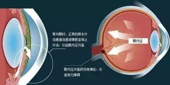 一种是急性发病的青光眼,最常见的是原发性急性闭角型青光眼,这种