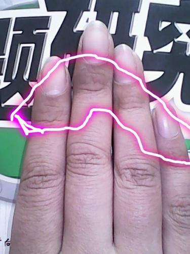 原创血管好不好,"手指"会告诉你?没有这3种表现,或是脑梗还很远