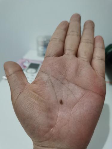 左手掌心痣