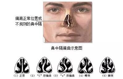 鼻中隔偏曲的危害,你了解多少