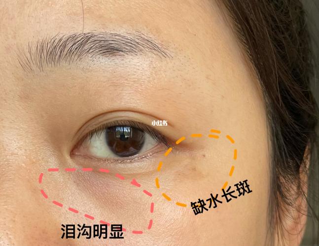 泪沟明显,眼角长斑护肤分享_泪沟_精华水_护肤分享_长