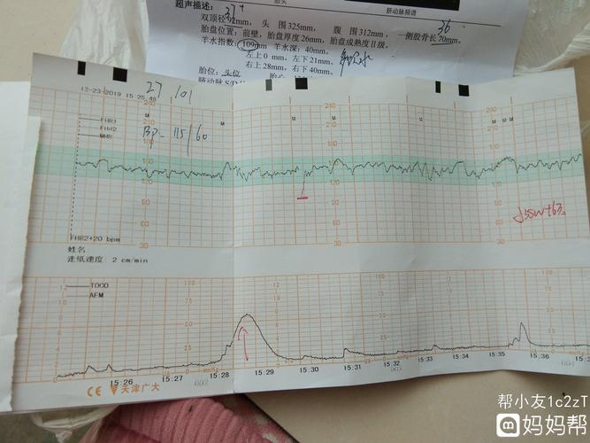 昨天做胎心监护,这是什么情况严重吗?