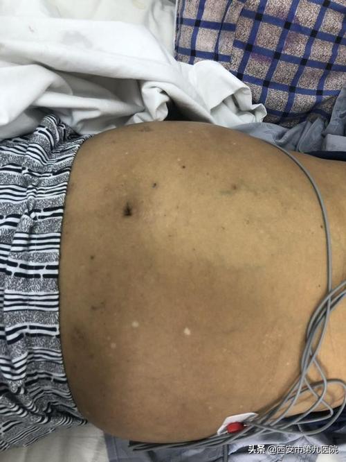 患者膨大的腹部明显可见腹壁静脉曲张