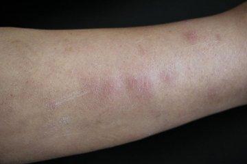 结节性红斑是怎么引起的呢