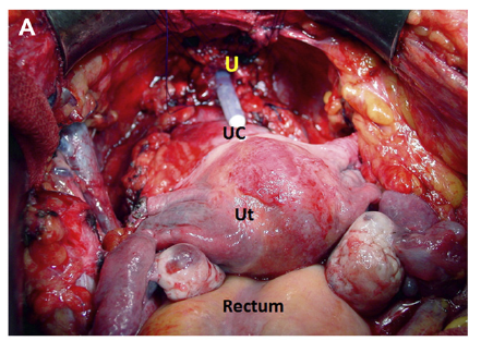 女性膀胱癌根治时是否都必须切除子宫,卵巢及阴道前壁