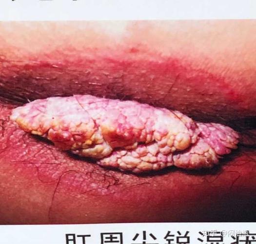尖锐湿疣,花菜样的赘生物!花菜 花菜
