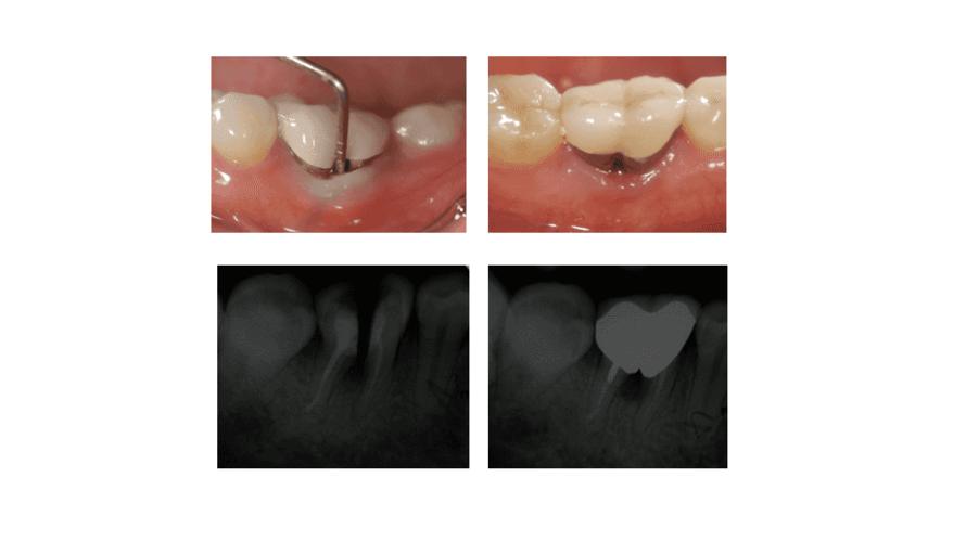 牙周病学根分叉病变