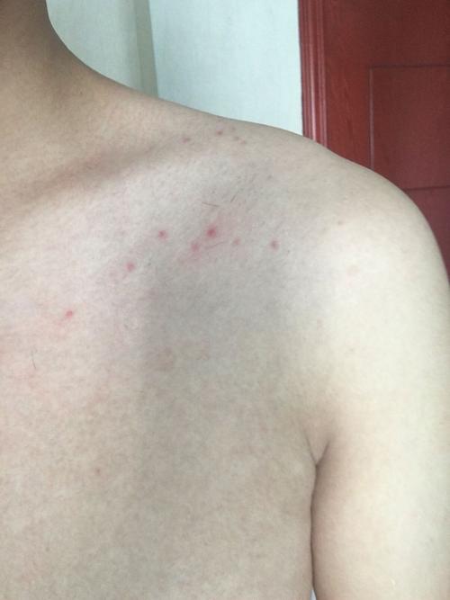 今天洗澡的时候看到起了很多小红点,我害怕有艾滋,心里紧张,今年十八.