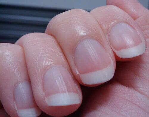 当患有蛔虫病,胃肠道疾病,贫血等病变时,指甲上也可能出现白点或白斑.