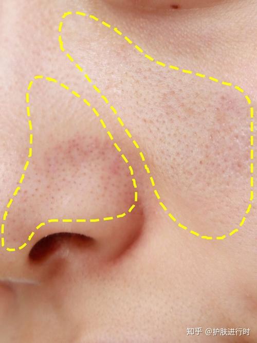 脸部毛周角化有什么改善的方法