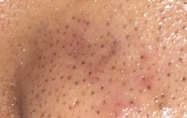 黑头这么多?那么恶心的 草莓鼻怎么办?-搜狐