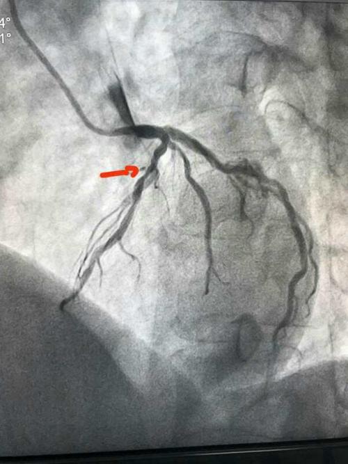 箭头所示:前降支管状病变,狭窄程度大于90%,d1开口受累