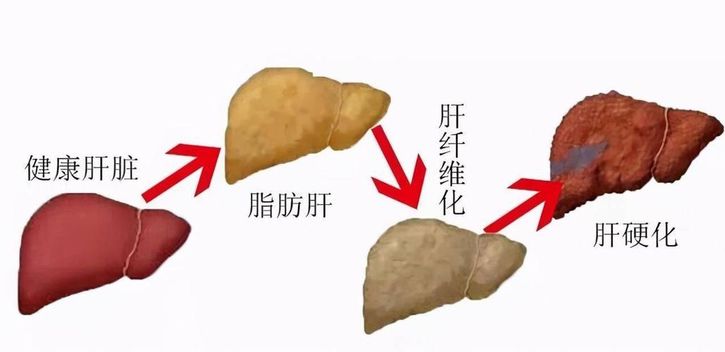 体检发现轻度脂肪肝要注意些什么?听说会增加死亡风险